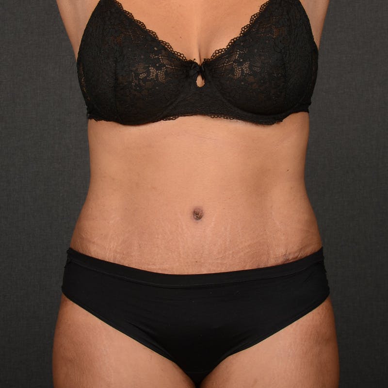 Tummy Tuck Before & After Gallery - Patient 290981 - Image 2