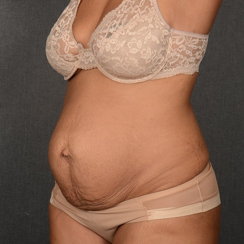Tummy Tuck Before & After Gallery - Patient 290981 - Image 3
