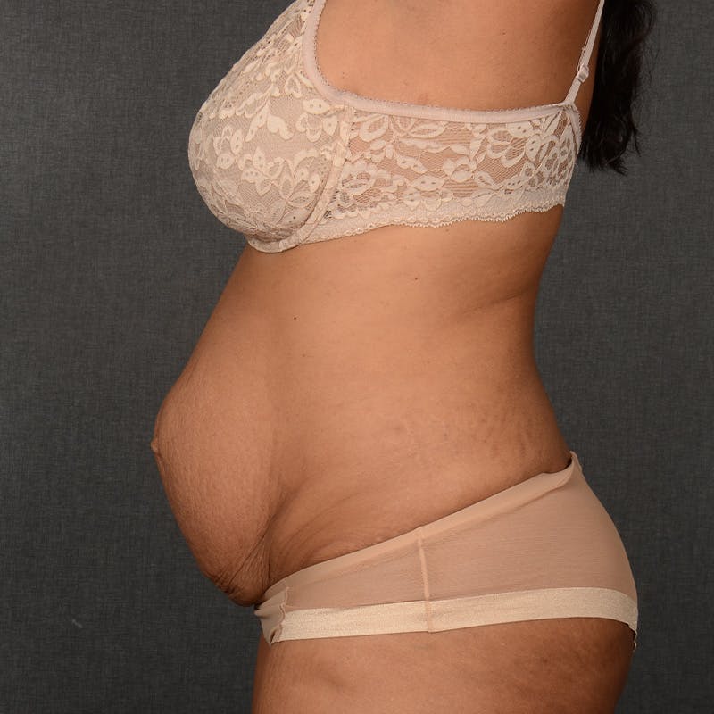 Tummy Tuck Before & After Gallery - Patient 290981 - Image 5