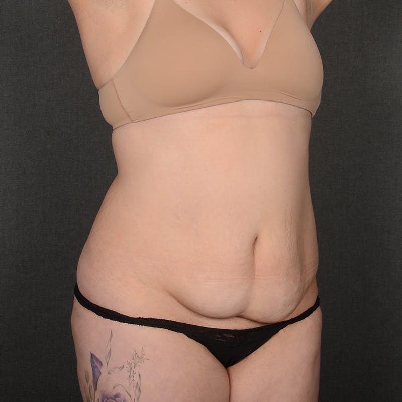 Tummy Tuck Before & After Gallery - Patient 377622 - Image 3