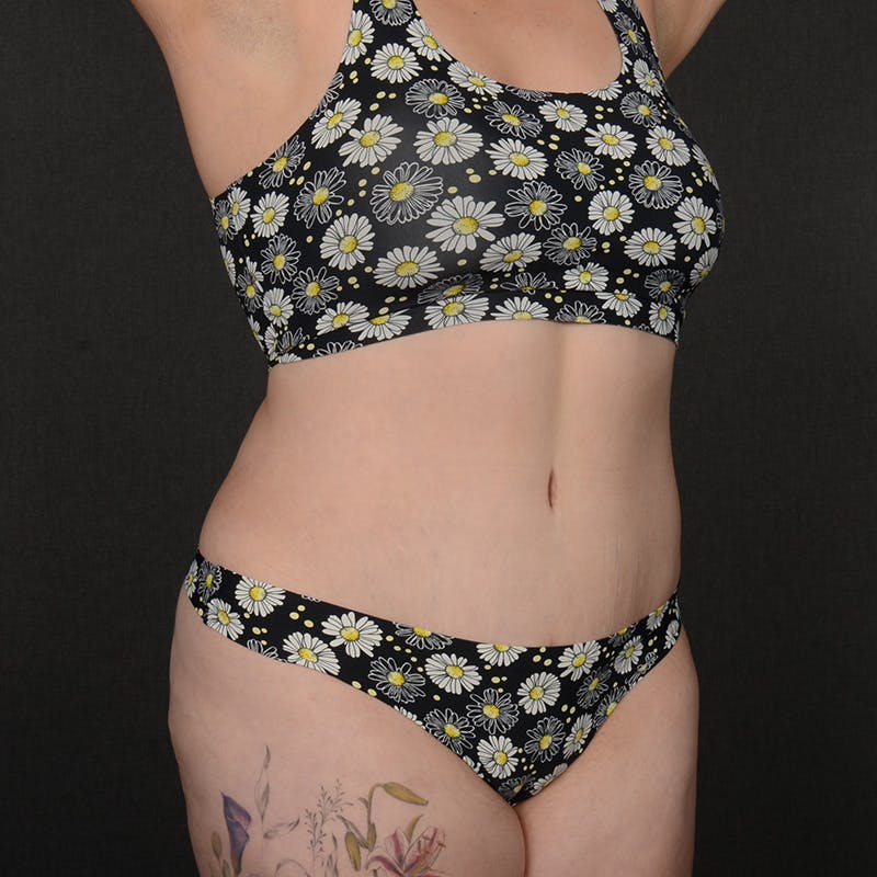 Tummy Tuck Before & After Gallery - Patient 377622 - Image 4