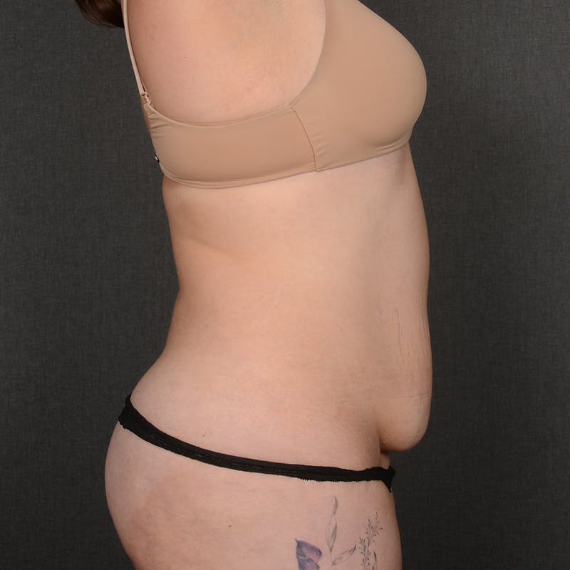 Tummy Tuck Before & After Gallery - Patient 377622 - Image 5