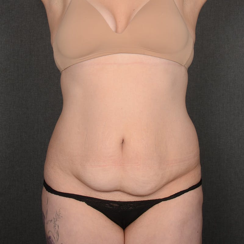 Tummy Tuck Before & After Gallery - Patient 377622 - Image 1
