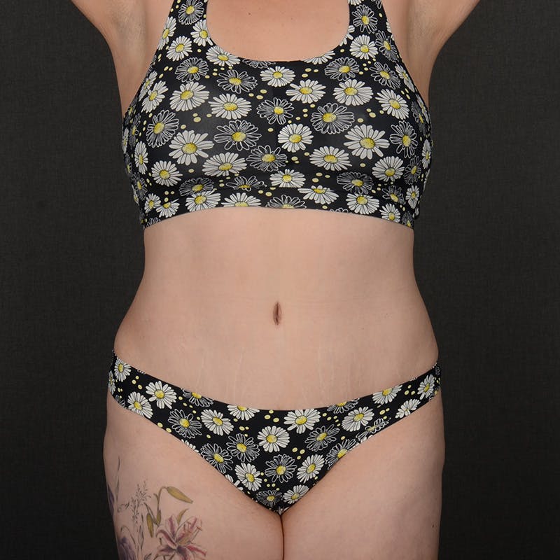 Tummy Tuck Before & After Gallery - Patient 377622 - Image 2