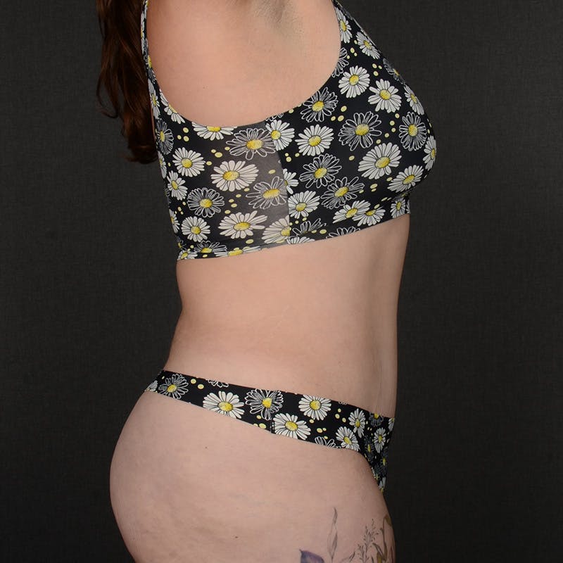 Tummy Tuck Before & After Gallery - Patient 377622 - Image 6