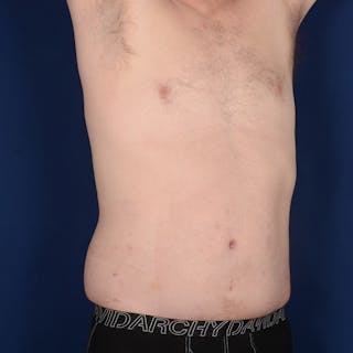 Tummy Tuck Before & After Gallery - Patient 214654 - Image 4