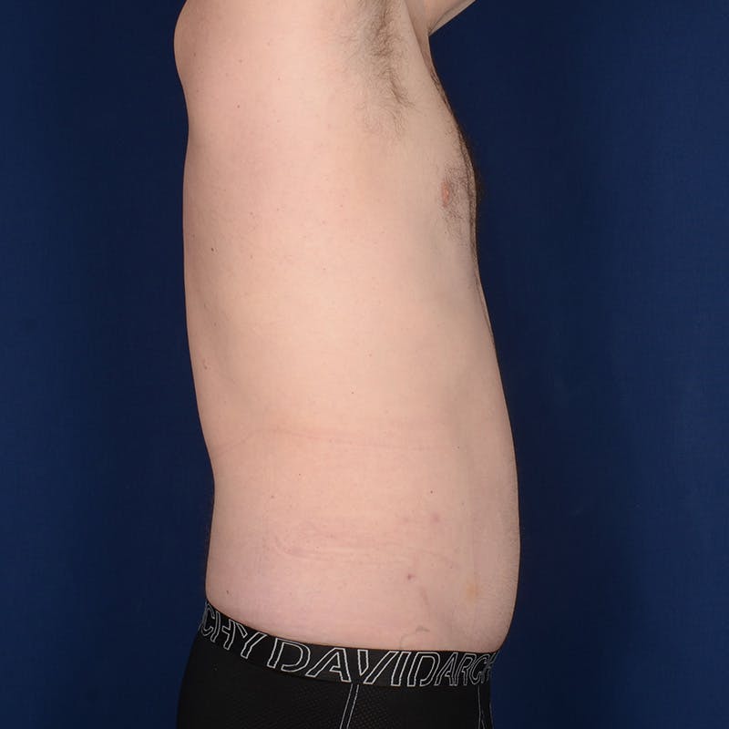 Tummy Tuck Before & After Gallery - Patient 214654 - Image 6