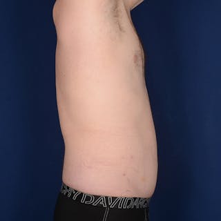 Tummy Tuck Before & After Gallery - Patient 214654 - Image 6