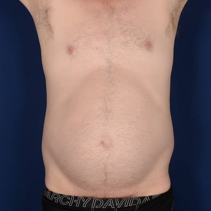 Tummy Tuck Before & After Gallery - Patient 214654 - Image 1