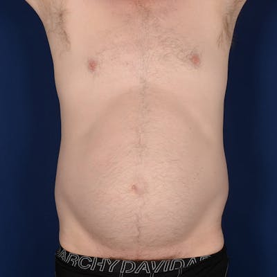 Tummy Tuck Before & After Gallery - Patient 214654 - Image 1