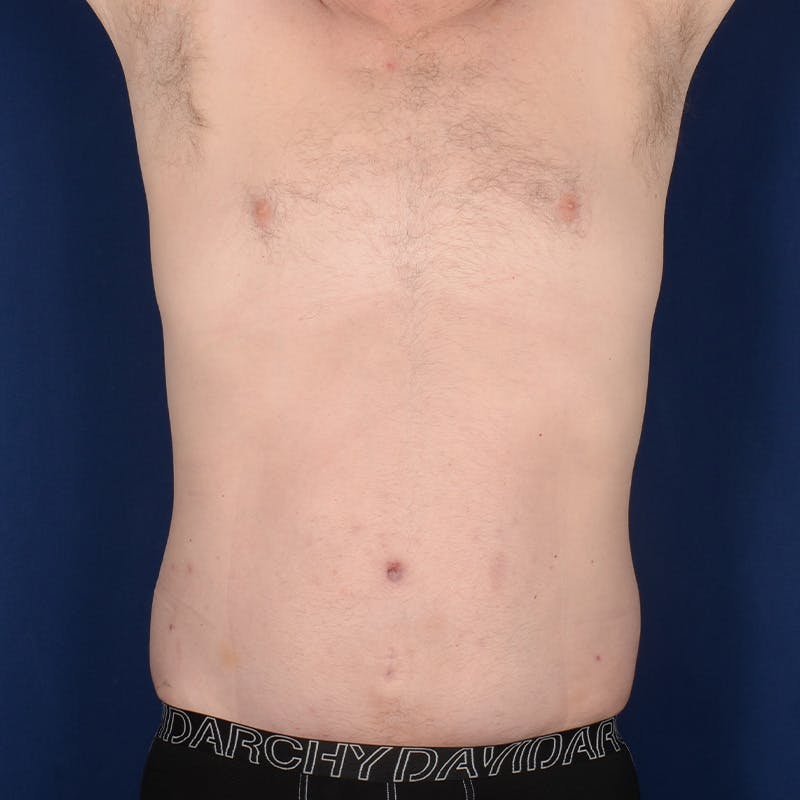 Tummy Tuck Before & After Gallery - Patient 214654 - Image 2