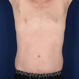 Tummy Tuck Before & After Gallery - Patient 214654 - Image 2