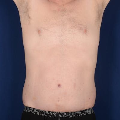 Tummy Tuck Before & After Gallery - Patient 214654 - Image 2