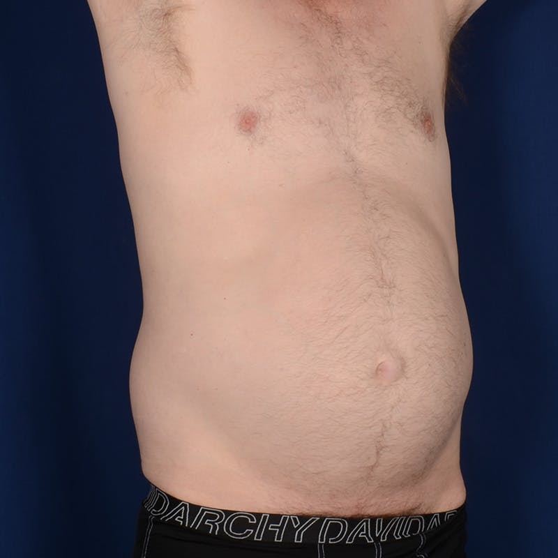 Tummy Tuck Before & After Gallery - Patient 214654 - Image 3