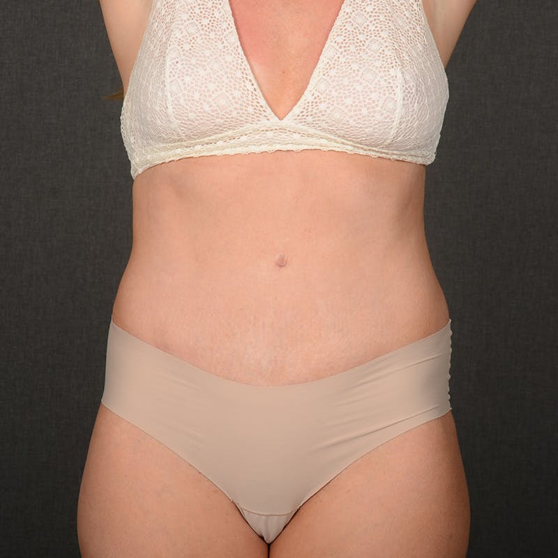 Tummy Tuck Before & After Gallery - Patient 337545 - Image 2
