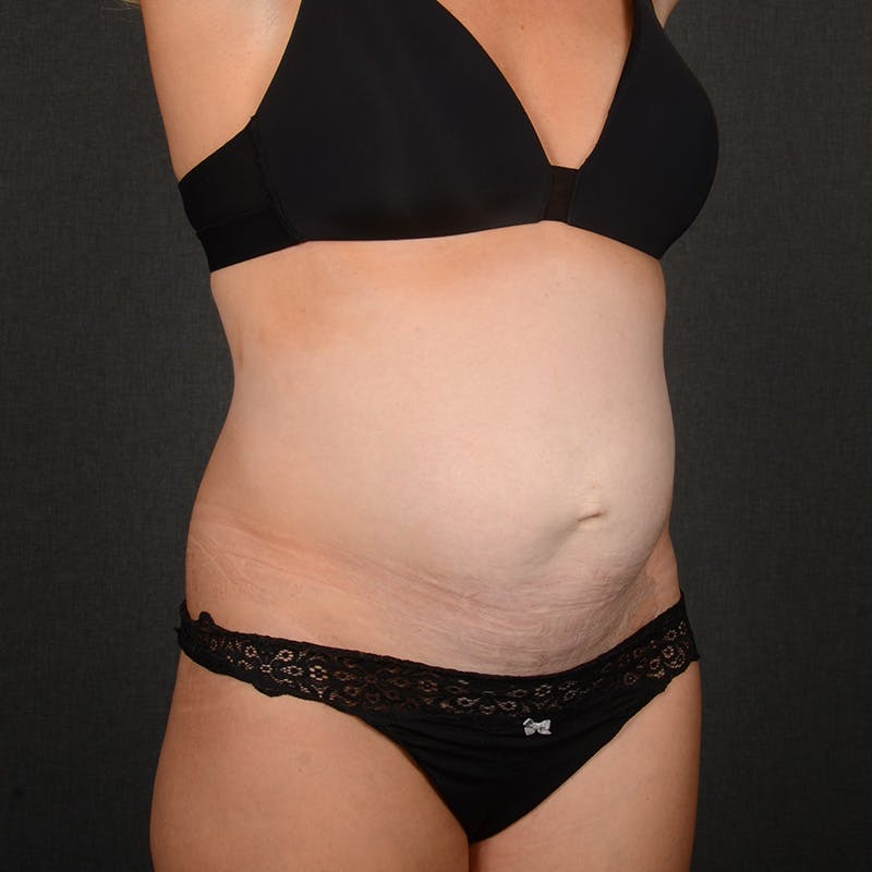 Tummy Tuck Before & After Gallery - Patient 337545 - Image 3