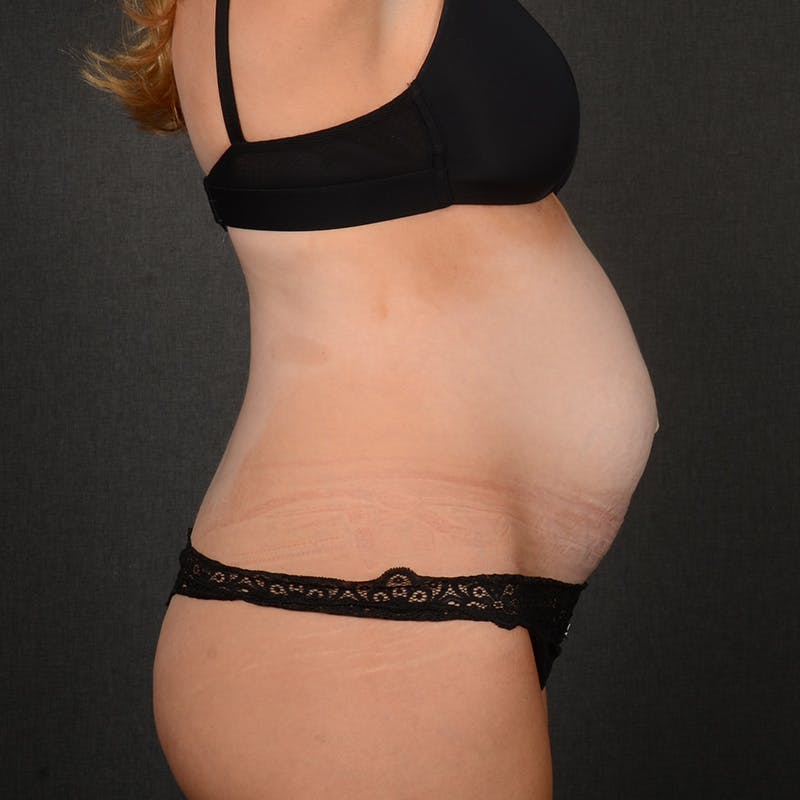 Tummy Tuck Before & After Gallery - Patient 337545 - Image 5