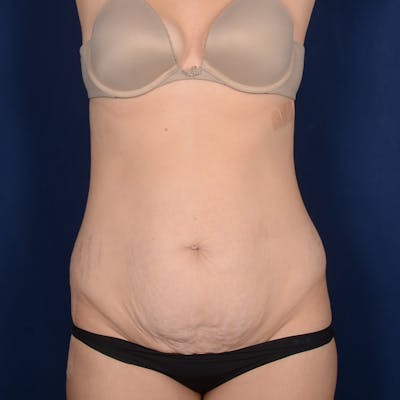 Tummy Tuck Before & After Gallery - Patient 190482 - Image 1