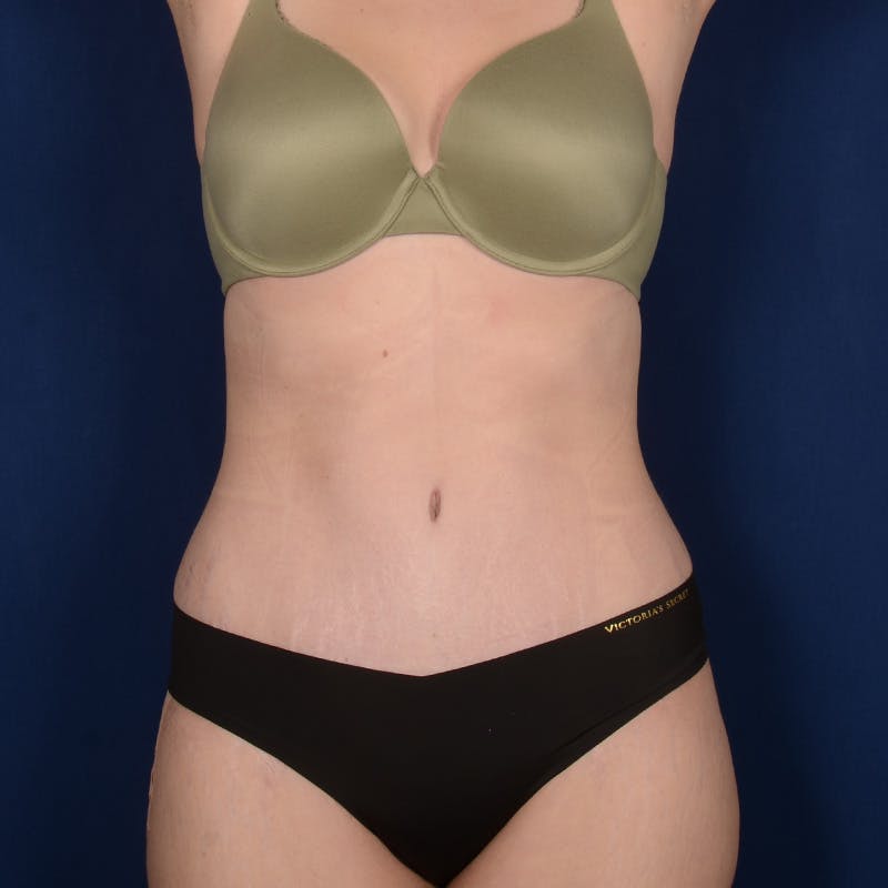 Tummy Tuck Before & After Gallery - Patient 190482 - Image 2