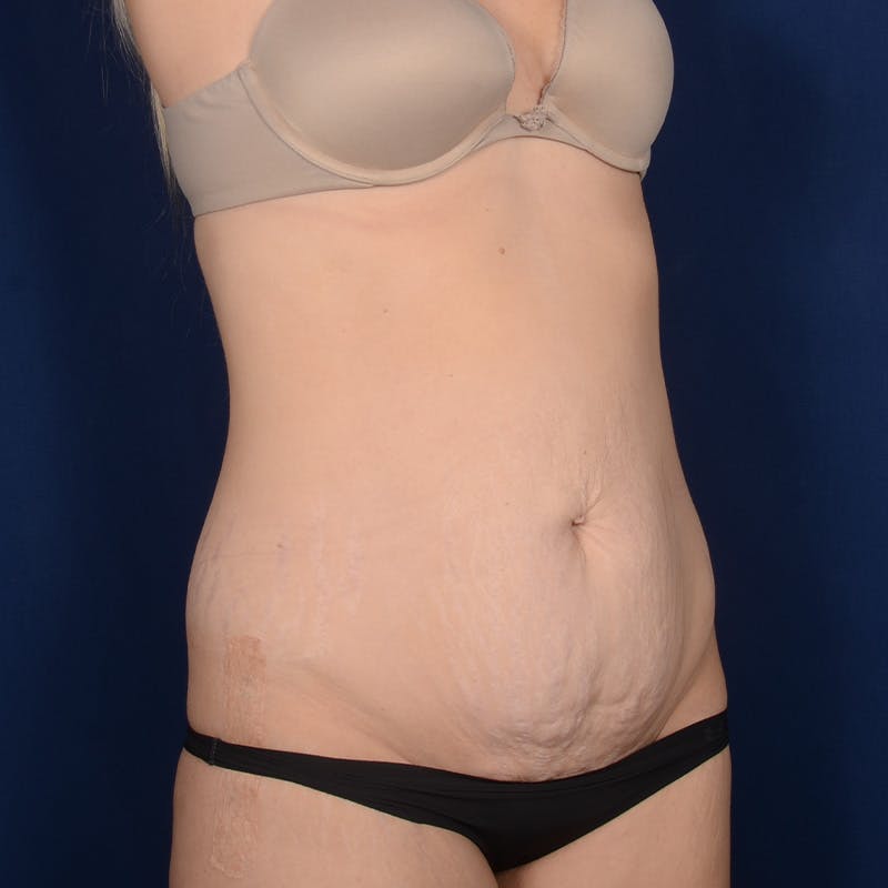 Tummy Tuck Before & After Gallery - Patient 190482 - Image 3