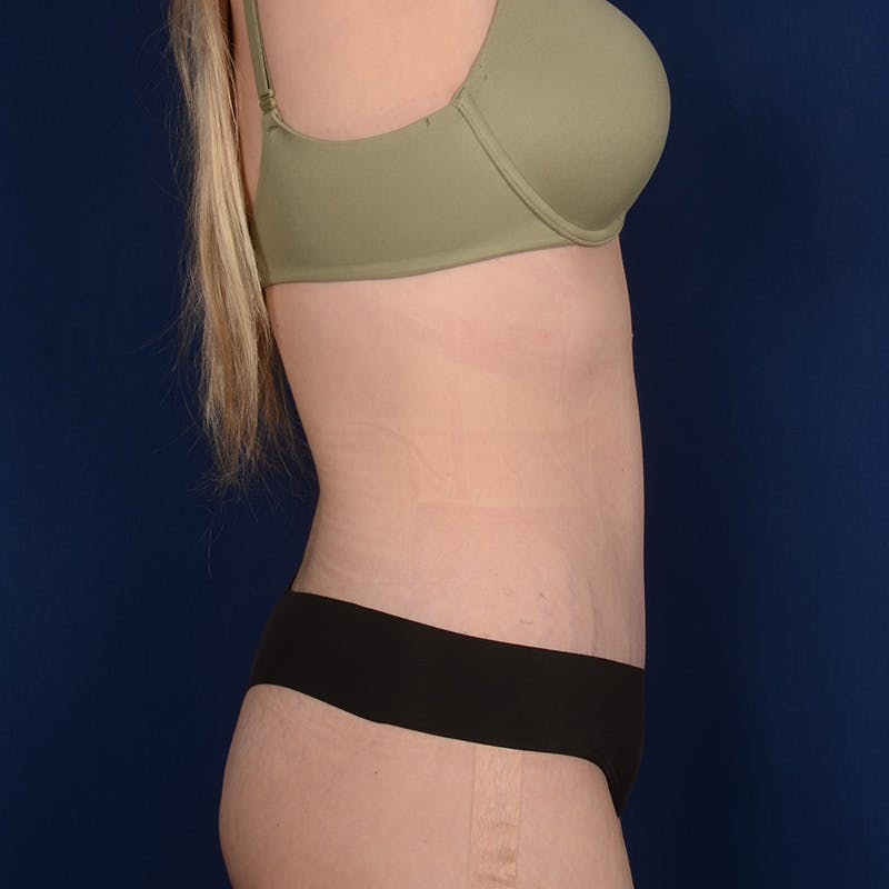 Tummy Tuck Before & After Gallery - Patient 190482 - Image 6