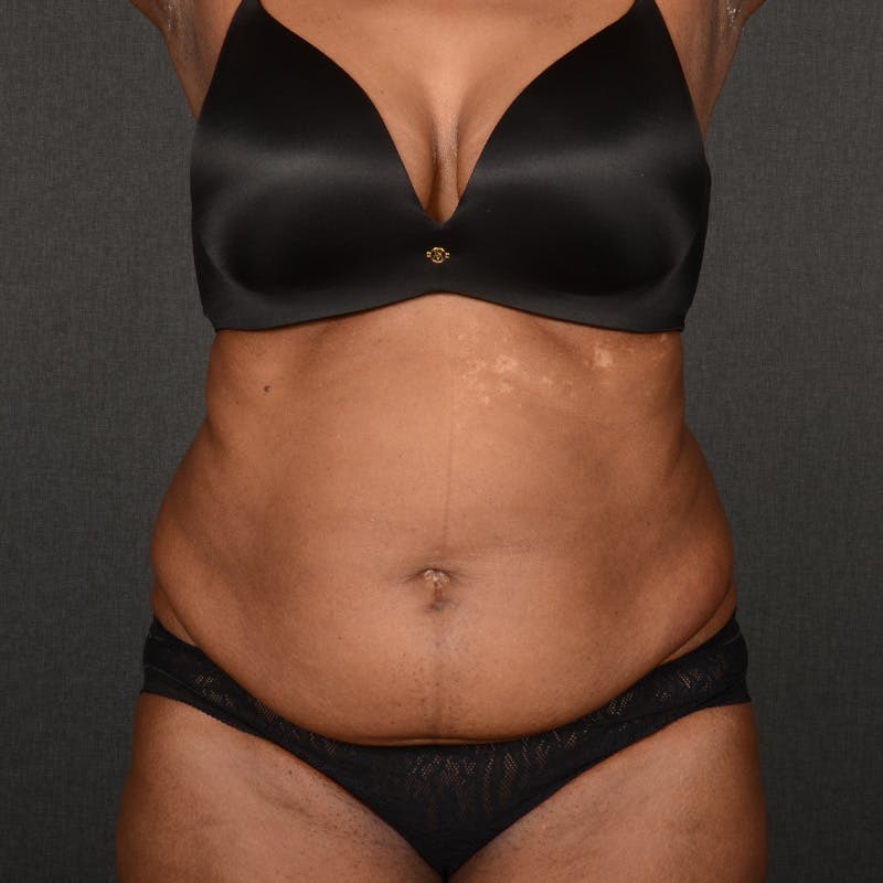 Tummy Tuck Before & After Gallery - Patient 937228 - Image 1