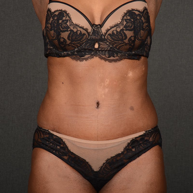 Tummy Tuck Before & After Gallery - Patient 937228 - Image 2