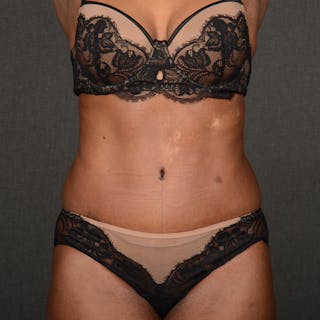 Tummy Tuck Before & After Gallery - Patient 937228 - Image 2