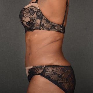 Tummy Tuck Before & After Gallery - Patient 937228 - Image 6
