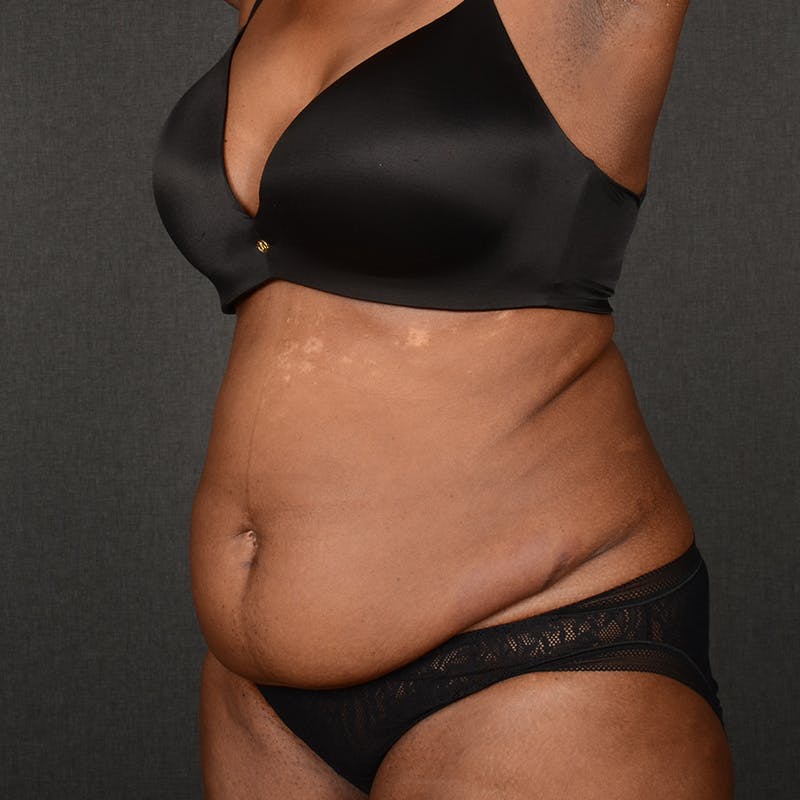 Tummy Tuck Before & After Gallery - Patient 937228 - Image 3