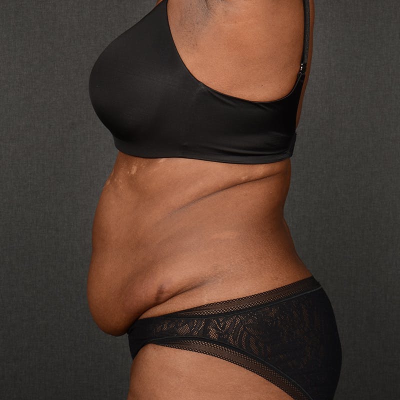 Tummy Tuck Before & After Gallery - Patient 937228 - Image 5