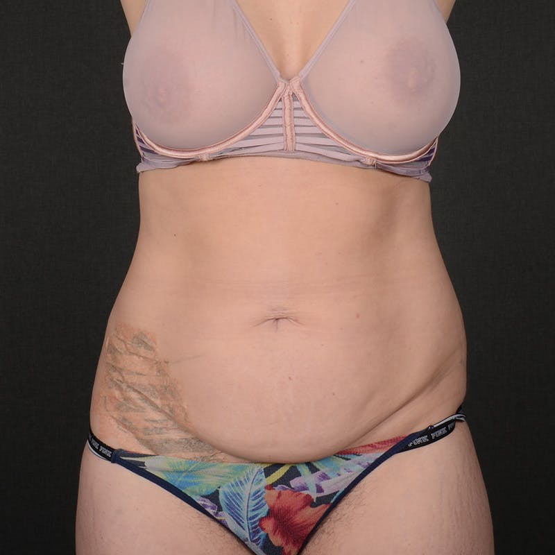 Tummy Tuck Before & After Gallery - Patient 672528 - Image 1