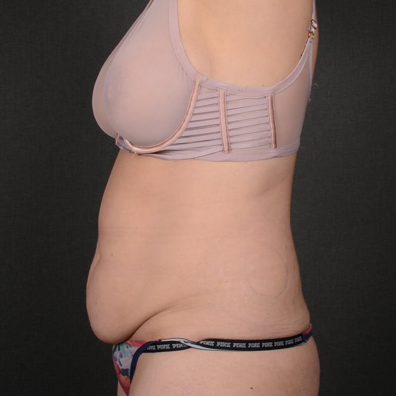 Tummy Tuck Before & After Gallery - Patient 672528 - Image 5