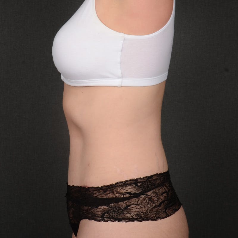 Tummy Tuck Before & After Gallery - Patient 672528 - Image 6