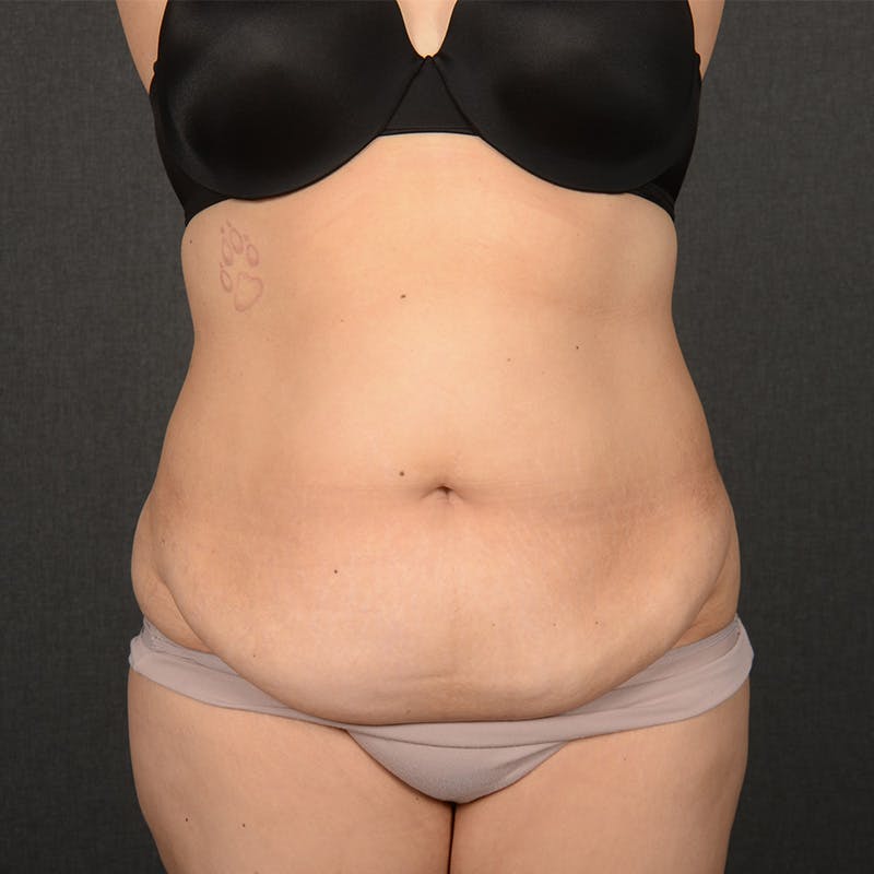 Tummy Tuck Before & After Gallery - Patient 396172 - Image 1