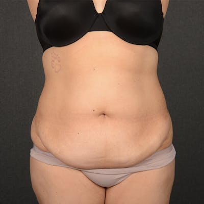Tummy Tuck Before & After Gallery - Patient 396172 - Image 1