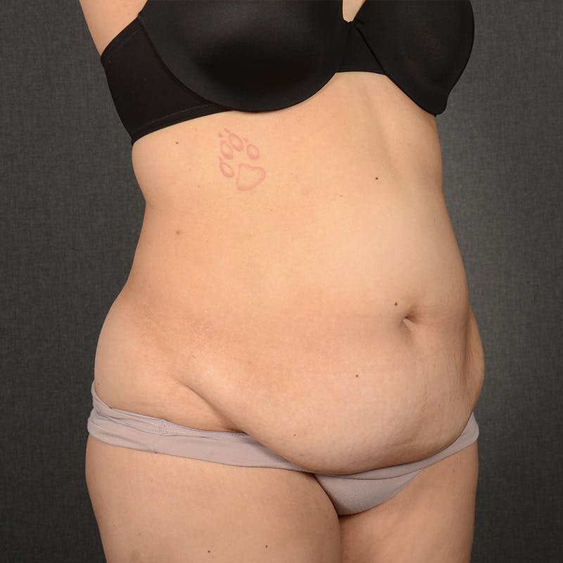 Tummy Tuck Before & After Gallery - Patient 396172 - Image 3