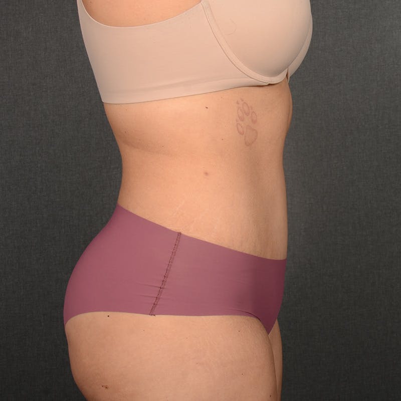 Tummy Tuck Before & After Gallery - Patient 396172 - Image 6