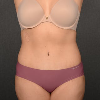 Tummy Tuck Before & After Gallery - Patient 396172 - Image 2