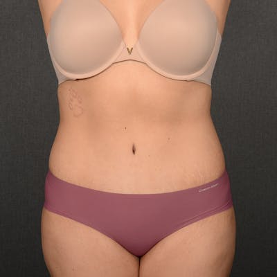 Tummy Tuck Before & After Gallery - Patient 396172 - Image 2