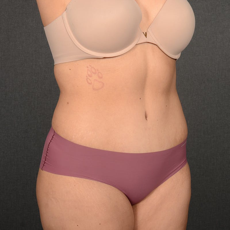 Tummy Tuck Before & After Gallery - Patient 396172 - Image 4
