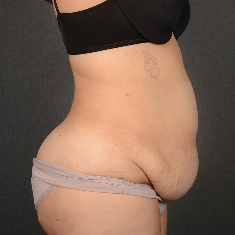 Tummy Tuck Before & After Gallery - Patient 396172 - Image 5