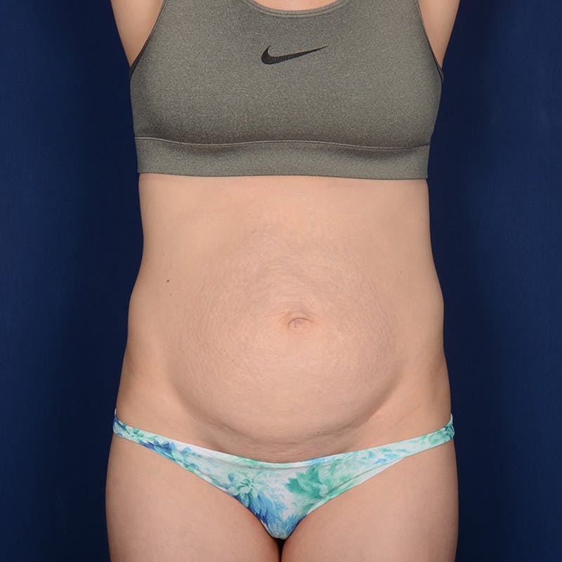 Tummy Tuck Before & After Gallery - Patient 383626 - Image 1