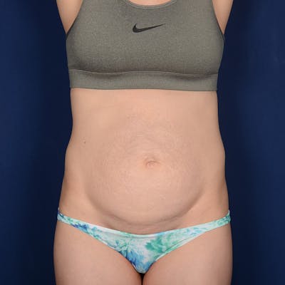 Tummy Tuck Before & After Gallery - Patient 383626 - Image 1