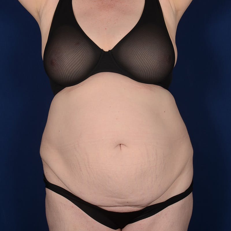 Tummy Tuck Before & After Gallery - Patient 144856 - Image 1