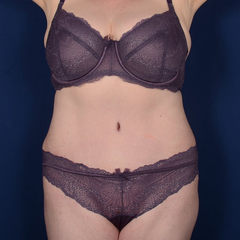 Tummy Tuck Before & After Gallery - Patient 144856 - Image 2