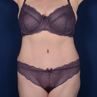 Tummy Tuck Before & After Gallery - Patient 144856 - Image 2