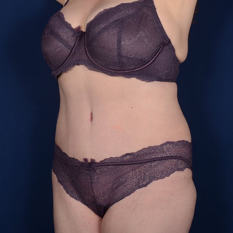 Tummy Tuck Before & After Gallery - Patient 144856 - Image 4