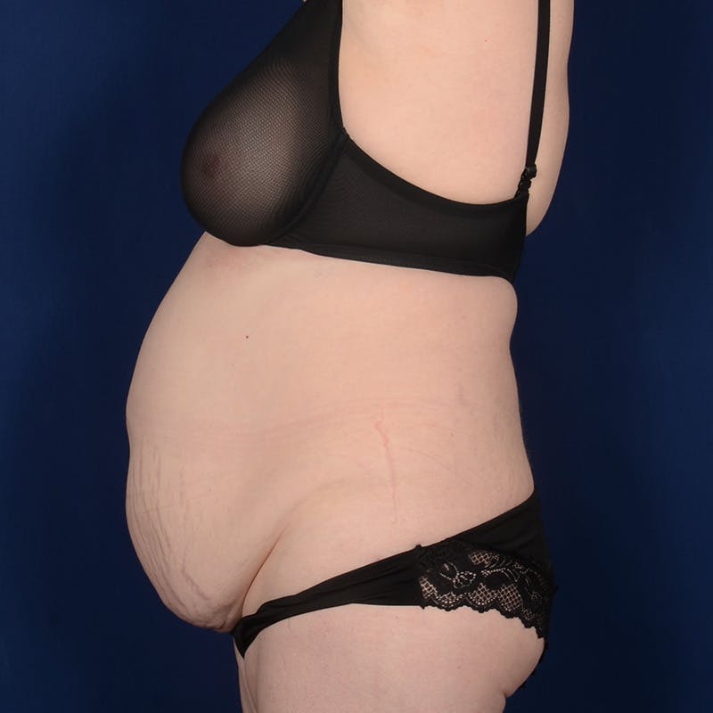Tummy Tuck Before & After Gallery - Patient 144856 - Image 5