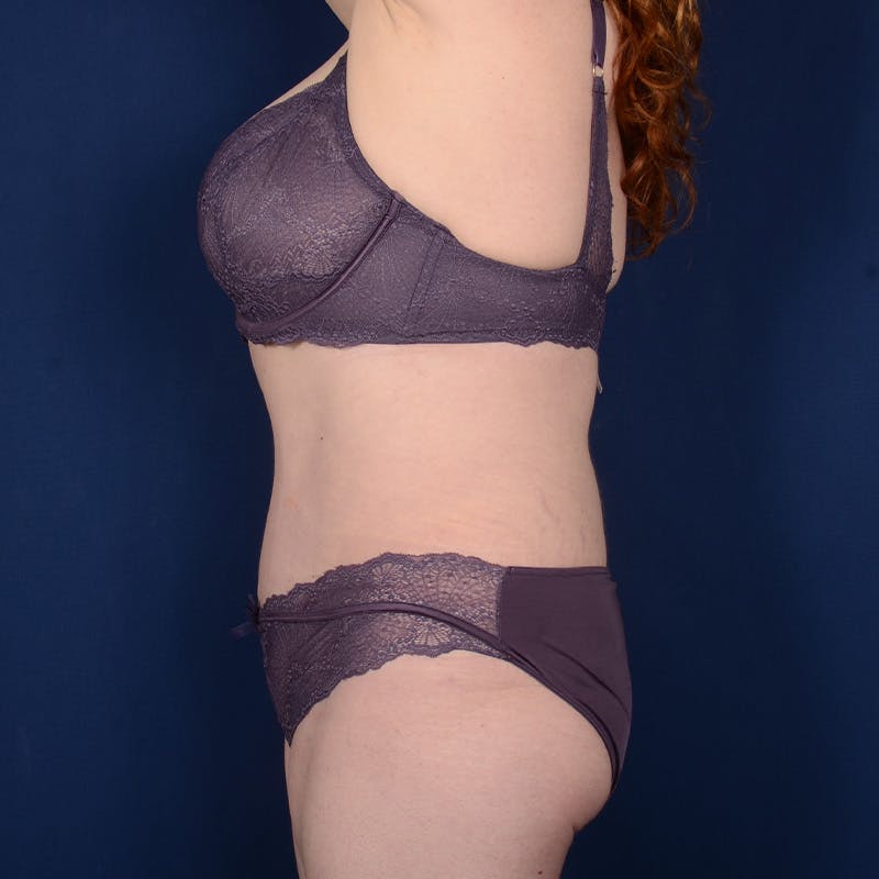 Tummy Tuck Before & After Gallery - Patient 144856 - Image 6